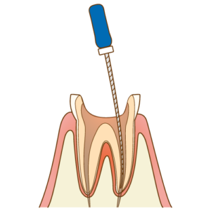 根の治療