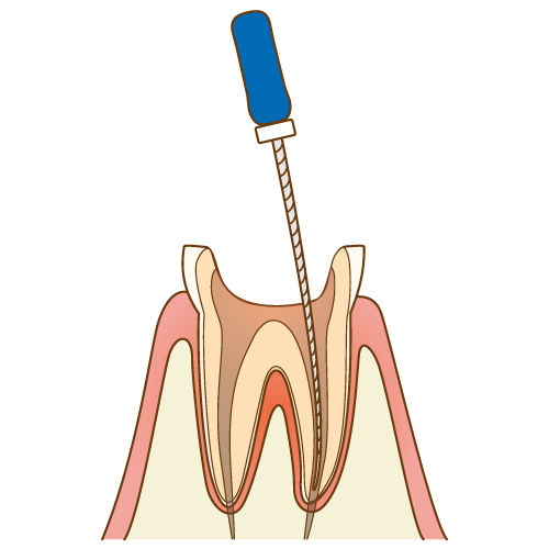 根の治療